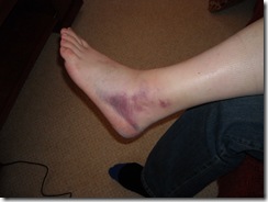 My injured ankle